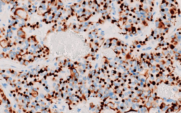 6F2 Paraganglioma (Case 6) CK 2