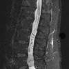 7A1 Paraganglioma (Case 7) STIR - CopyA