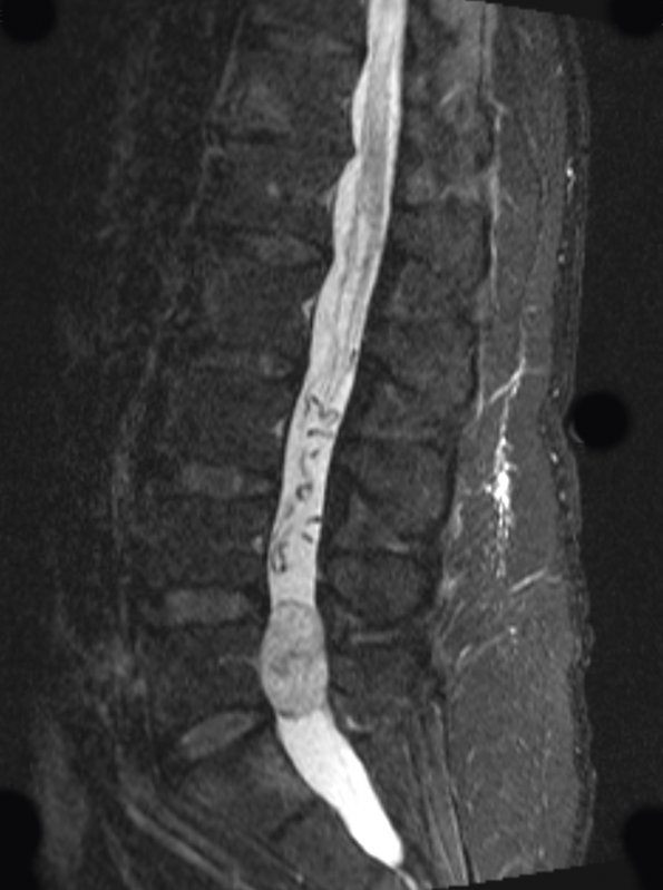 7A1 Paraganglioma (Case 7) STIR - CopyA