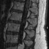 7A2 Paraganglioma (Case 7) T1 W - CopyA