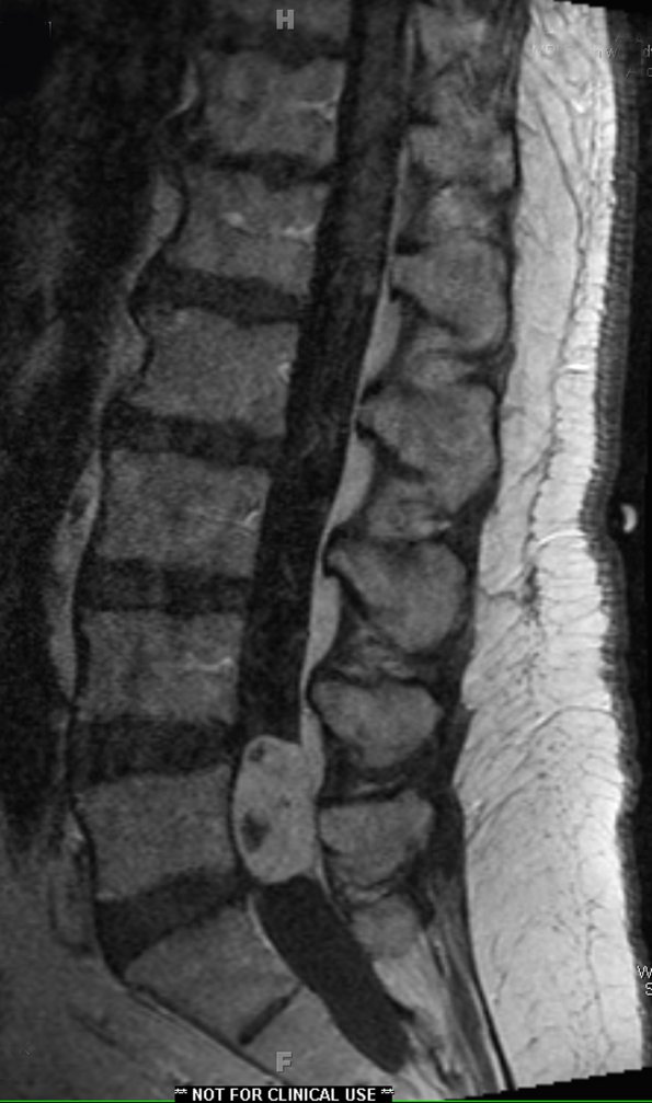 7A2 Paraganglioma (Case 7) T1 W - CopyA