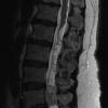 7A3 Paraganglioma (Case 7) RESTORE 1 - CopyA