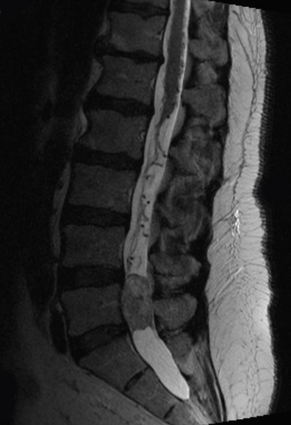 7A3 Paraganglioma (Case 7) RESTORE 1 - CopyA