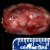 7B1 Paraganglioma (Case 7) Gross 1