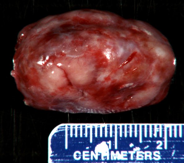 7B1 Paraganglioma (Case 7) Gross 1