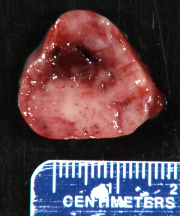 7B2 Paraganglioma (Case 7) Gross 3