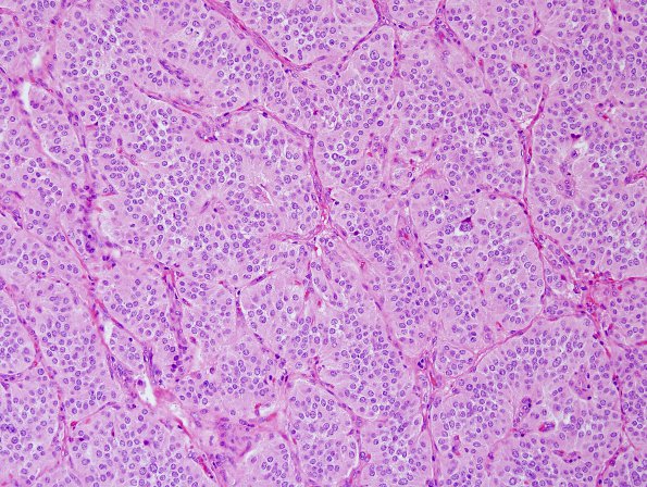 7C1 Paraganglioma (Case 7) H&E 20X.jpg