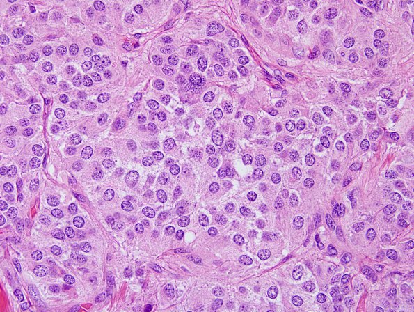 7C2 Paraganglioma (Case 7) H&E 60X.jpg