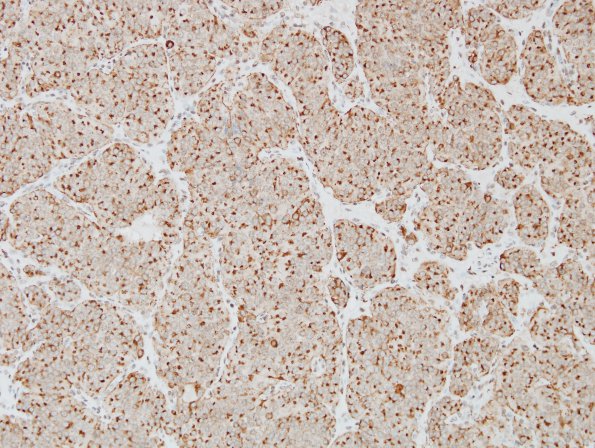 7E1 Paraganglioma (Case 7) Chromogranin 20X.jpg