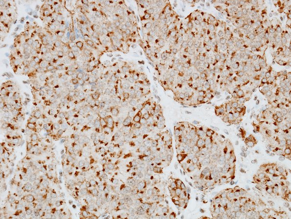 7E2 Paraganglioma (Case 7) Chromogranin 40X.jpg