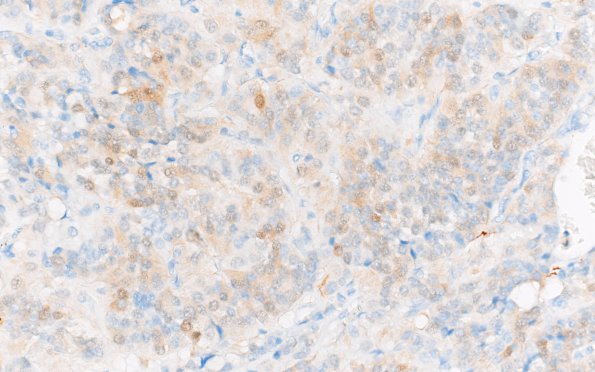 7F1 Paraganglioma (Case 7) S100 40X