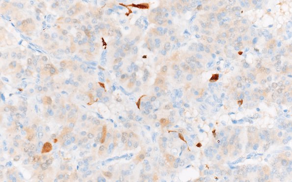 7F2 Paraganglioma (Case 7) S100 40X 2