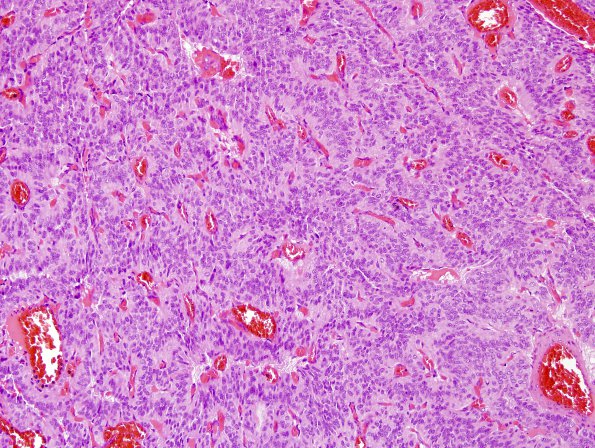 8A1 Paraganglioma (Case 8) H&E 1.jpg