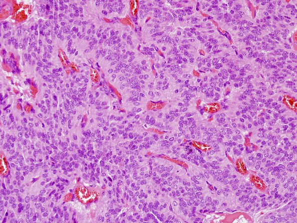 8A2 Paraganglioma (Case 8) H&E 2.jpg