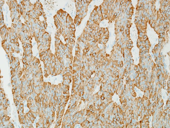 8B2 Paraganglioma (Case 8) SYN 1.jpg