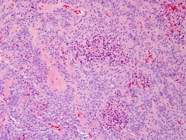 9A1 Paraganglioma (Case 9) H&E 2.jpg