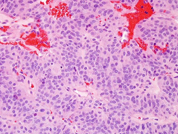 9A2 Paraganglioma (Case 9) H&E 3.jpg