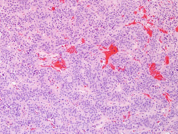 9A3 Paraganglioma (Case 9) H&E 4.jpg