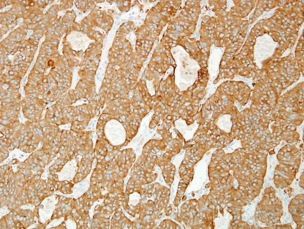 9B1 Paraganglioma (Case 9) SYN 2.jpg