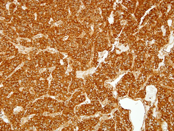 9C1 Paraganglioma (Case 9) O13 1.jpg