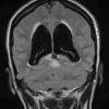 4A4 RGNT (Case 4) T2 W Dark Fluid 1 - Copy