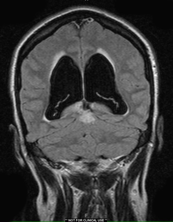 4A4 RGNT (Case 4) T2 W Dark Fluid 1 - Copy