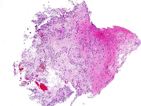 4B1 RGNT (Case 4) H&E 5