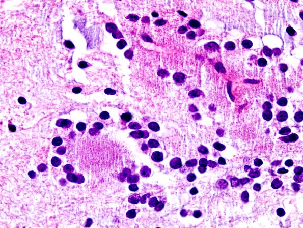 4B5 RGNT (Case 4) H&E 16