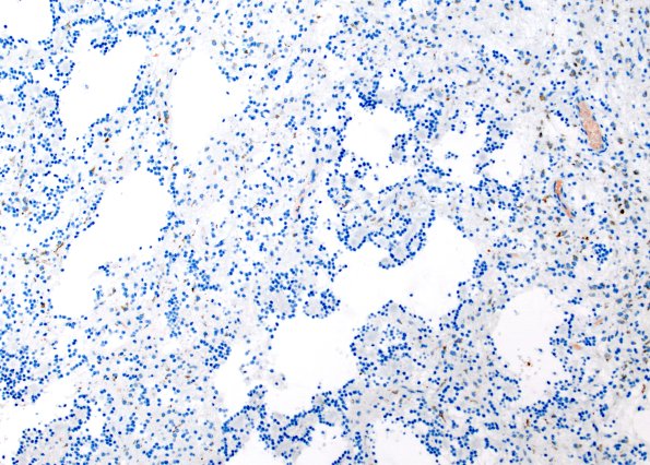 5E RGNT (Case 5) Chromogranin 2