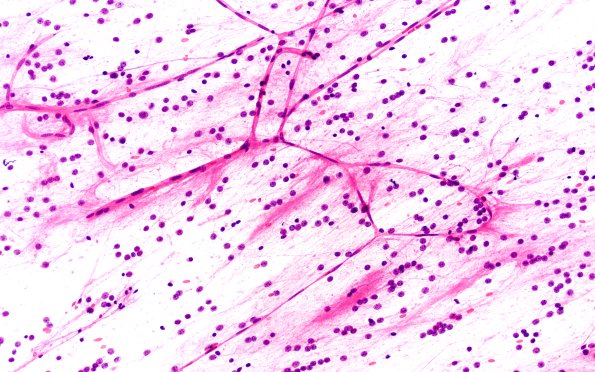 6C1 RGNT (Case 6) Smear H&E 20X