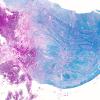 Adenoid Cystic Carcinoma (A31033) a