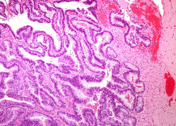 10A1 Choroid Plexus CA (Case 10) H&E 3