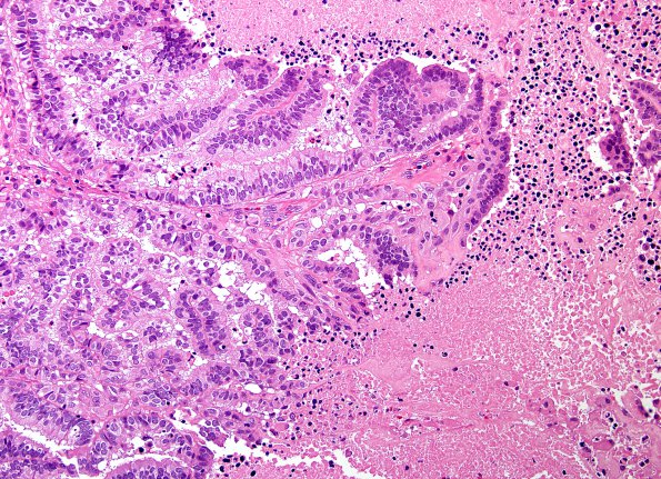 10A2 Choroid Plexus CA (Case 10) H&E 1