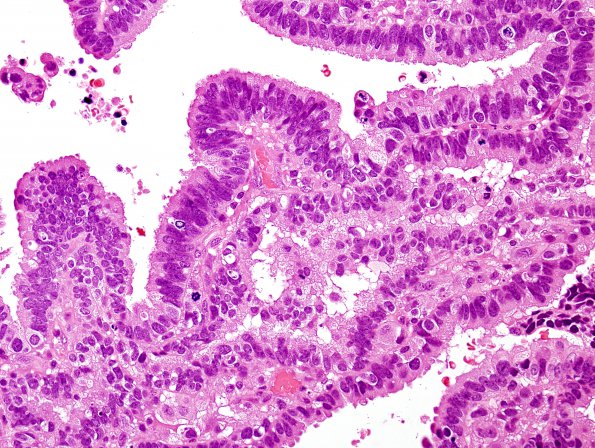 10A3 Choroid Plexus CA (Case 10) H&E 2