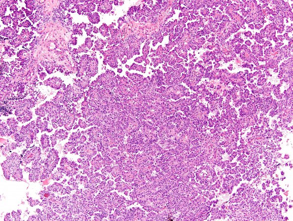 11A1 Choroid Plexus Carcinoma (Case 11) H&E 3