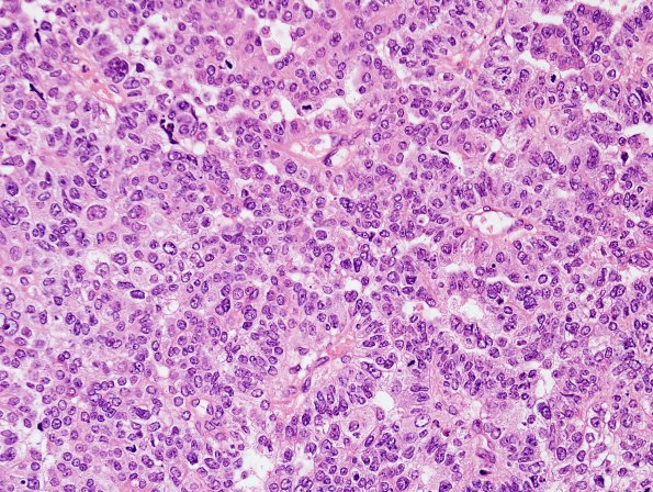 11A2 Choroid Plexus Carcinoma (Case 11) H&E 2