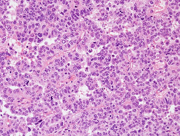 11A3 Choroid Plexus Carcinoma (Case 11) H&E 1