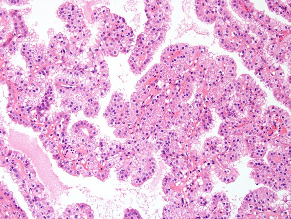 11A4 CPC (Case 11) H&E 5 (normal adjacent CP