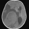 1A1 Choroid Plexus Carcinoma (Case 1) T1 1 - Copy