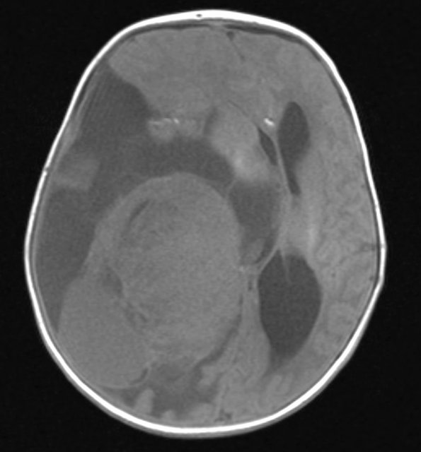 1A1 Choroid Plexus Carcinoma (Case 1) T1 1 - Copy