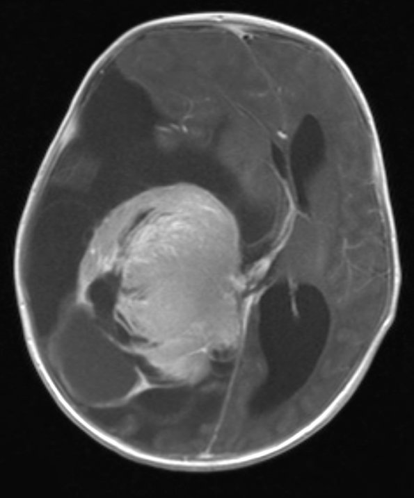 1A2 Choroid Plexus Carcinoma (Case 1) T1 W 2 - Copy