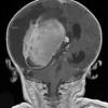 1A3 Choroid Plexus Carcinoma (Case 1) T1 W 3 - Copy