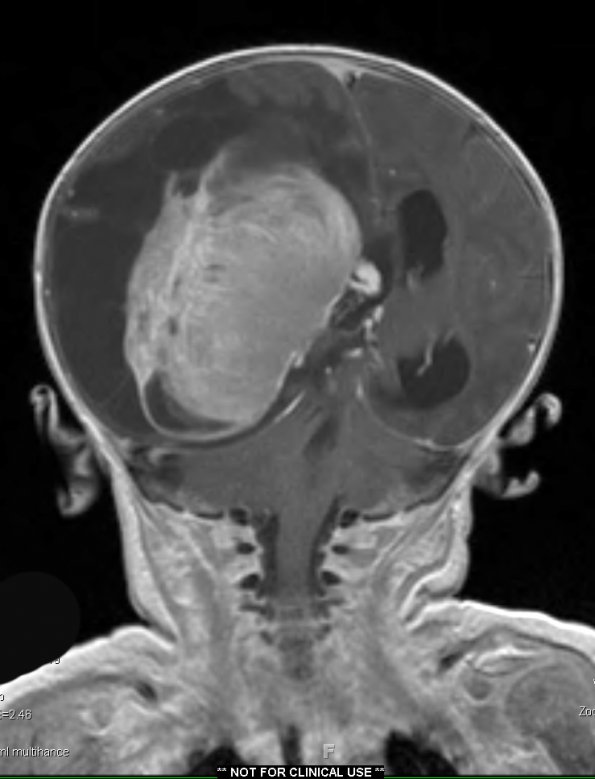 1A3 Choroid Plexus Carcinoma (Case 1) T1 W 3 - Copy