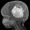 1A4 Choroid Plexus Carcinoma (Case 1) T1 W 4 - Copy