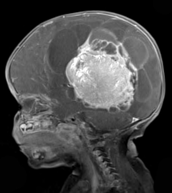 1A4 Choroid Plexus Carcinoma (Case 1) T1 W 4 - Copy