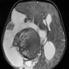 1A5 Choroid Plexus Carcinoma (Case 1) T2 1 - Copy