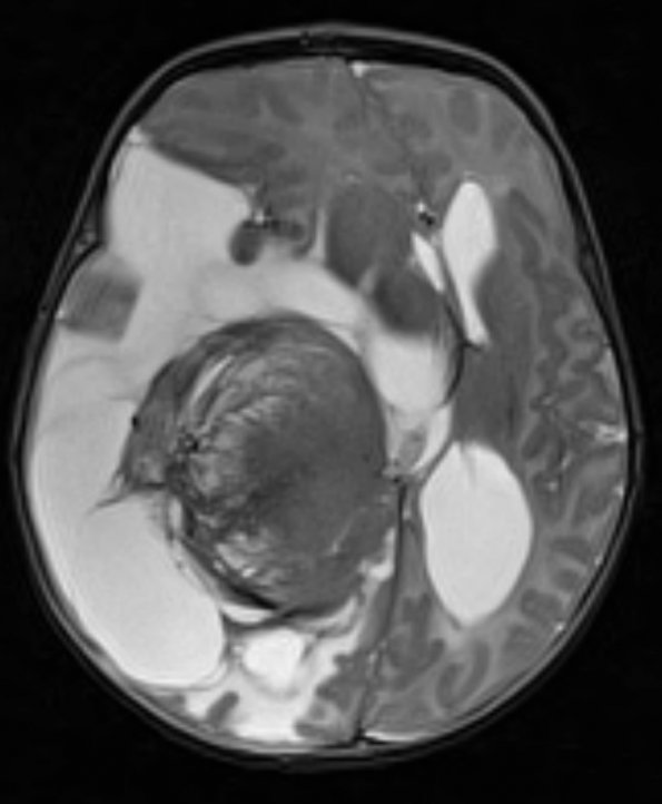 1A5 Choroid Plexus Carcinoma (Case 1) T2 1 - Copy