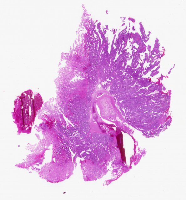 1B1 Choroid Plexus Carcinoma (Case 1) H&E WM