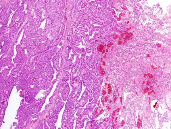 1B2 Choroid Plexus Carcinoma (Case 1) H&E 6