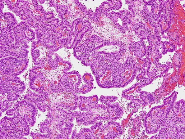 1B3 Choroid Plexus Carcinoma (Case 1) H&E 3